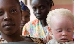 Día Internacional de Sensibilización sobre el Albinismo  – 13 de junio