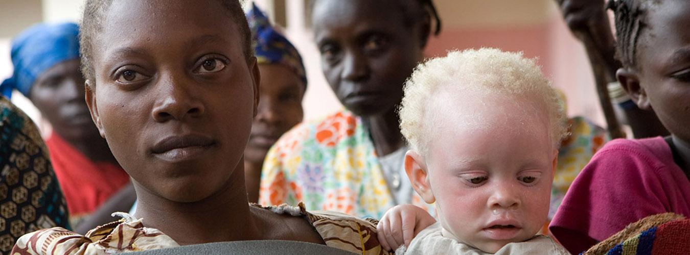 Lee más sobre el artículo Día Internacional de Sensibilización sobre el Albinismo  – 13 de junio